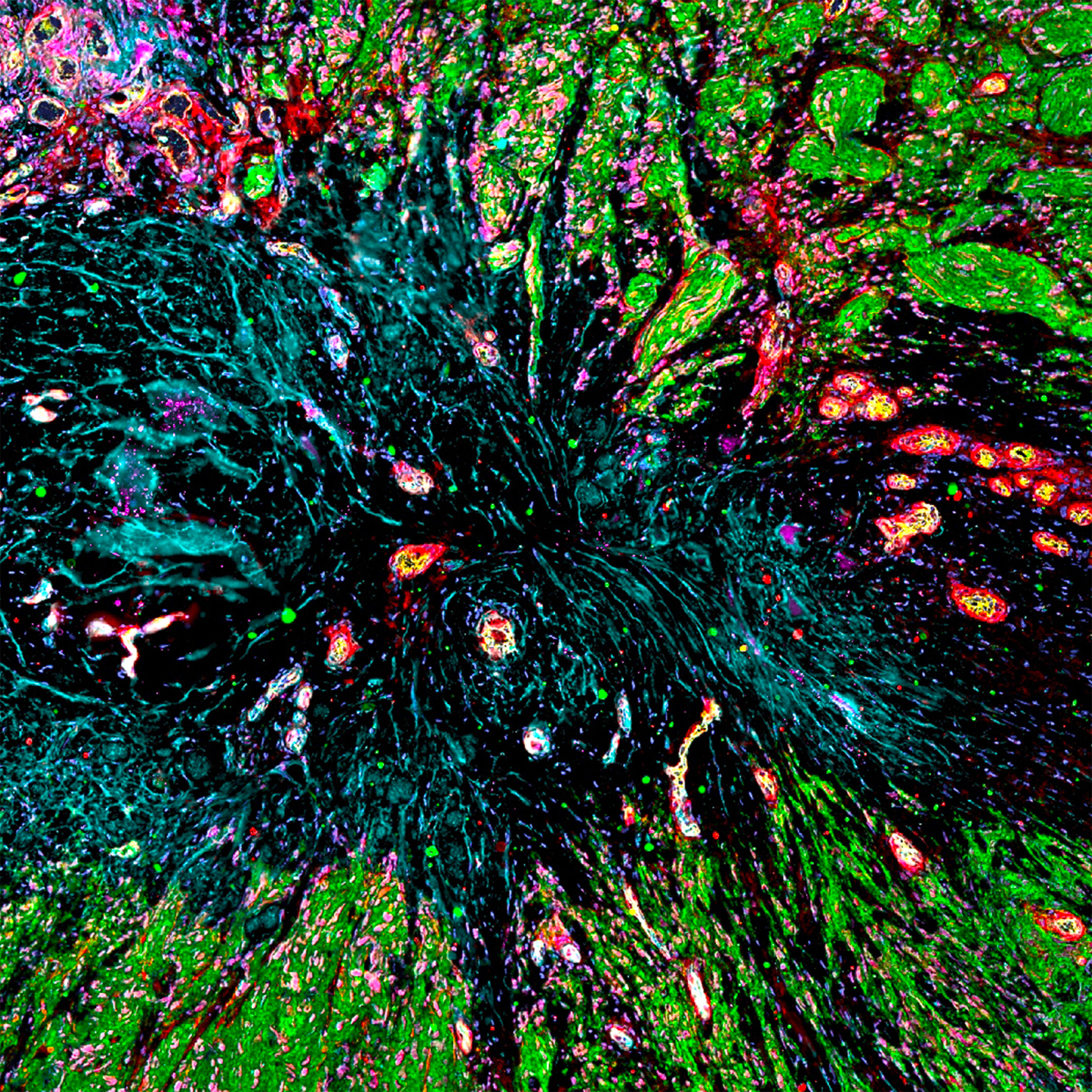 Hyperplexed image of a glioblastoma fibrotic core, caused by treatment of the primary tumor. Cells in green are recurrent tumor growth emanating from the core.