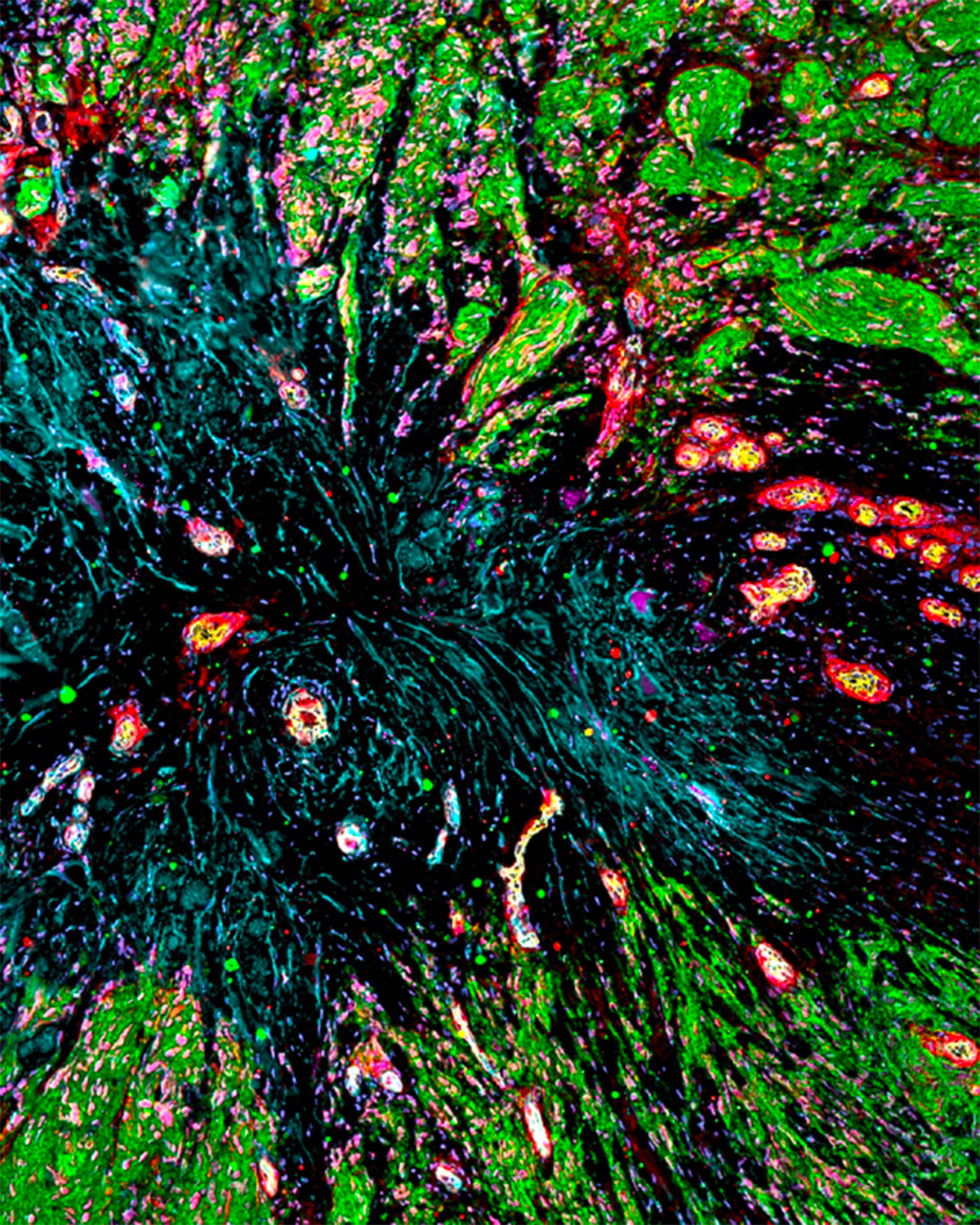 Hyperplexed image of a glioblastoma fibrotic core, caused by treatment of the primary tumor. Cells in green are recurrent tumor growth emanating from the core.